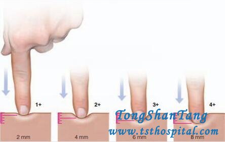 Will Edema in Polycystic Kidney Disease Get Improved