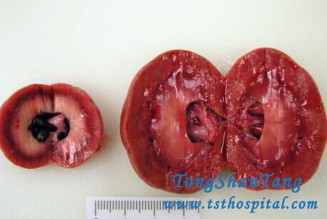 Treatment of Kidney Atrophy