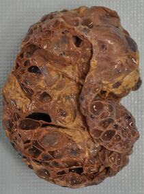 Improve Kidney Function in Kidney Failure with PKD by Natural Treatment