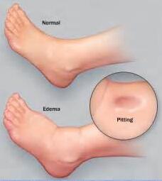 Cure Severe Edema in Lupus Nephritis with Toxin-Removing Therapy