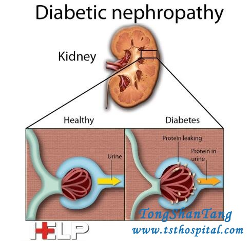 Can I Take Sweet Food in Diabetic Nephropathy