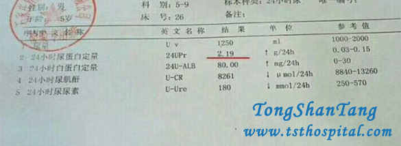 Proteinuria In Lupus Nephritis Is Reduced Effectively In Our Hospital