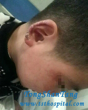 Proteinuria In Lupus Nephritis Is Reduced Effectively In Our Hospital