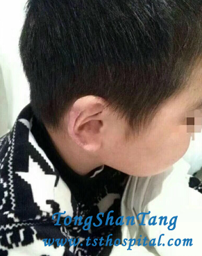 Proteinuria In Lupus Nephritis Is Reduced Effectively In Our Hospital