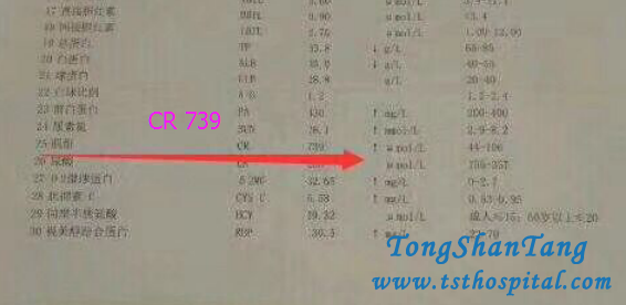 No Dialysis, How To Reduce High Creatinine Level 700umol/L