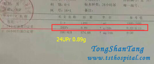 Chinese Medicines Help You Avoid Relapse of Proteinuria