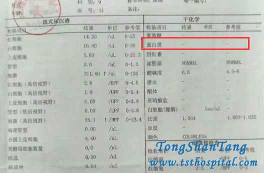 Eliminate Relapse of Proteinuria In Nephrotic Syndrome