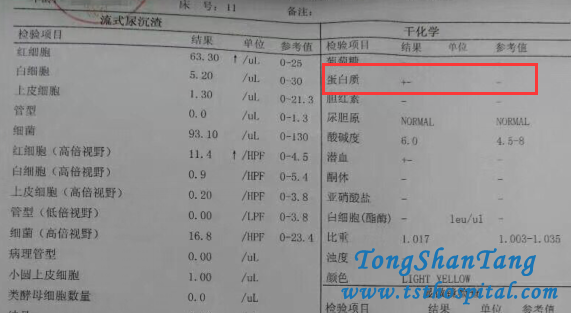 Toxin-Removing Treatment Help You Avoid IgA Nephropathy
