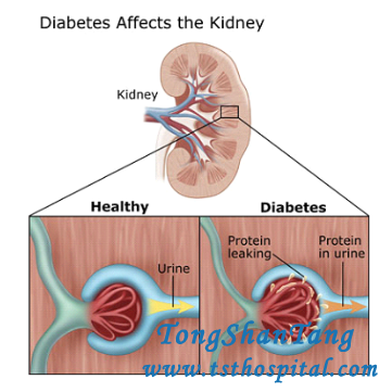 Diabetes: Does Creatinine 2.8 Mean I Have Kidney Problems