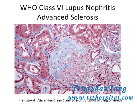 Treatment for Lupus Nephritis Class 6