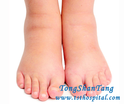 Kidney Disease: Is There Any Chance for Swelling to Get Cure 100%