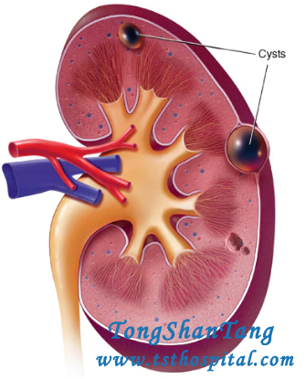 Is A Kidney Cyst Measuring 4x4x5 cm Large Enough to Be Drained