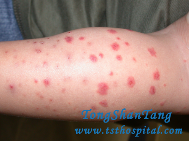 Purpura Is Easy to Be Misdiagnosed