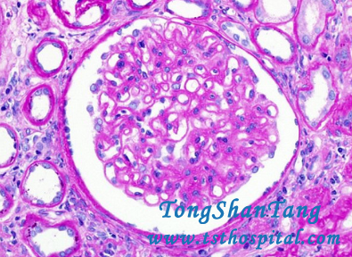Crescent Glomerulonephritis May Develop into Complete Kidney Failure Within Several Months