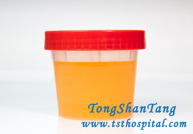 4 Items of Examination Must Be Done if You Have Proteinuria