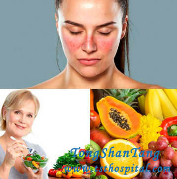 Dietary Principles for Lupus Nephritis Patients